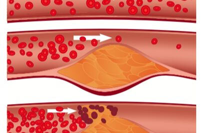 Cross-Institutional Study Looks within Arteries to Understand Effects of Cholesterol Medications 