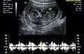 Research Team Develops Pacemaker to Save the Lives of Unborn Babies